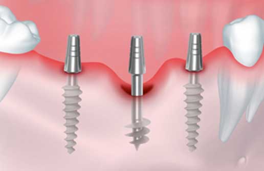 Implantes Basales