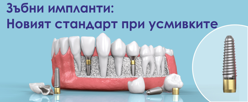 Поставяне на зъбни импланти: Новият стандарт при усмивките