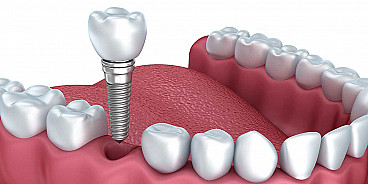 3 вида зъбни импланти