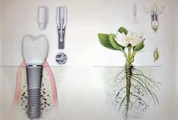 Implantacion dental