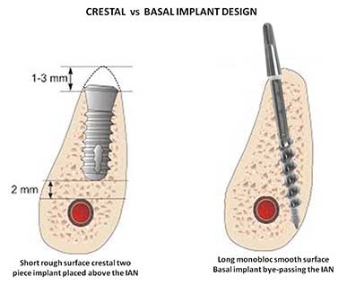 DENTAL IMPLANTATION crestal vs basal implant