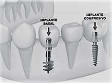 зъбни импланти имплантация