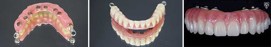 Provisorische Zahnprothesen